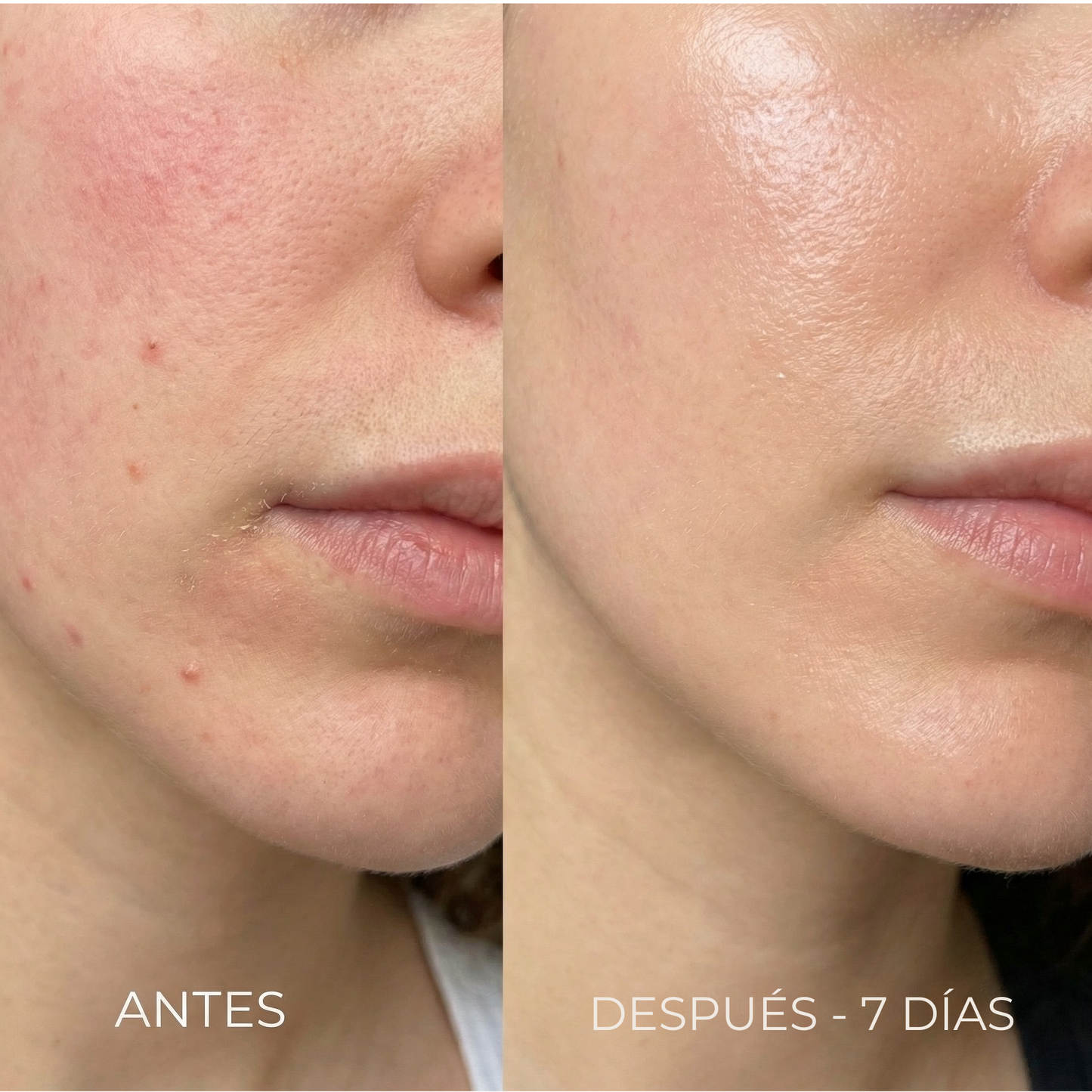 Renova® Piel Renovada